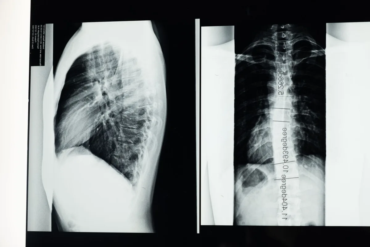 Radiografias da coluna vertebral mostrando curvatura lateral de escoliose